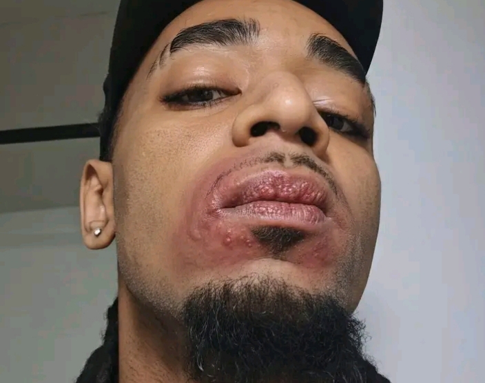 Solo Kutz confirmed pimples on his lips after meeting with a lady